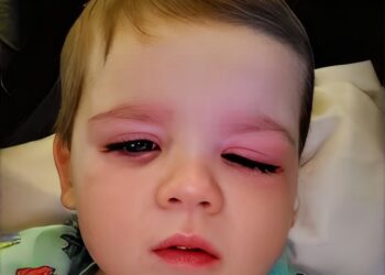 Opgepast! Moeder waarschuwt voor populair speelgoed dat haar zoontje bijna blind maakte